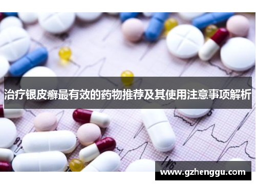 治疗银皮癣最有效的药物推荐及其使用注意事项解析 治疗银皮癣最有效的药物推荐及其使用注意事项解析